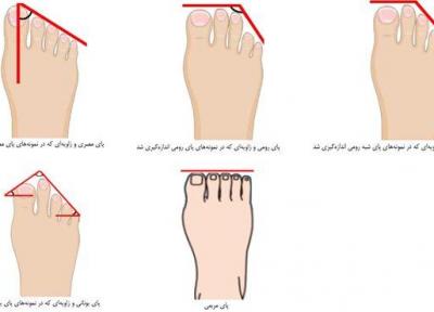 پای ایرانیان چه شکلی است؟